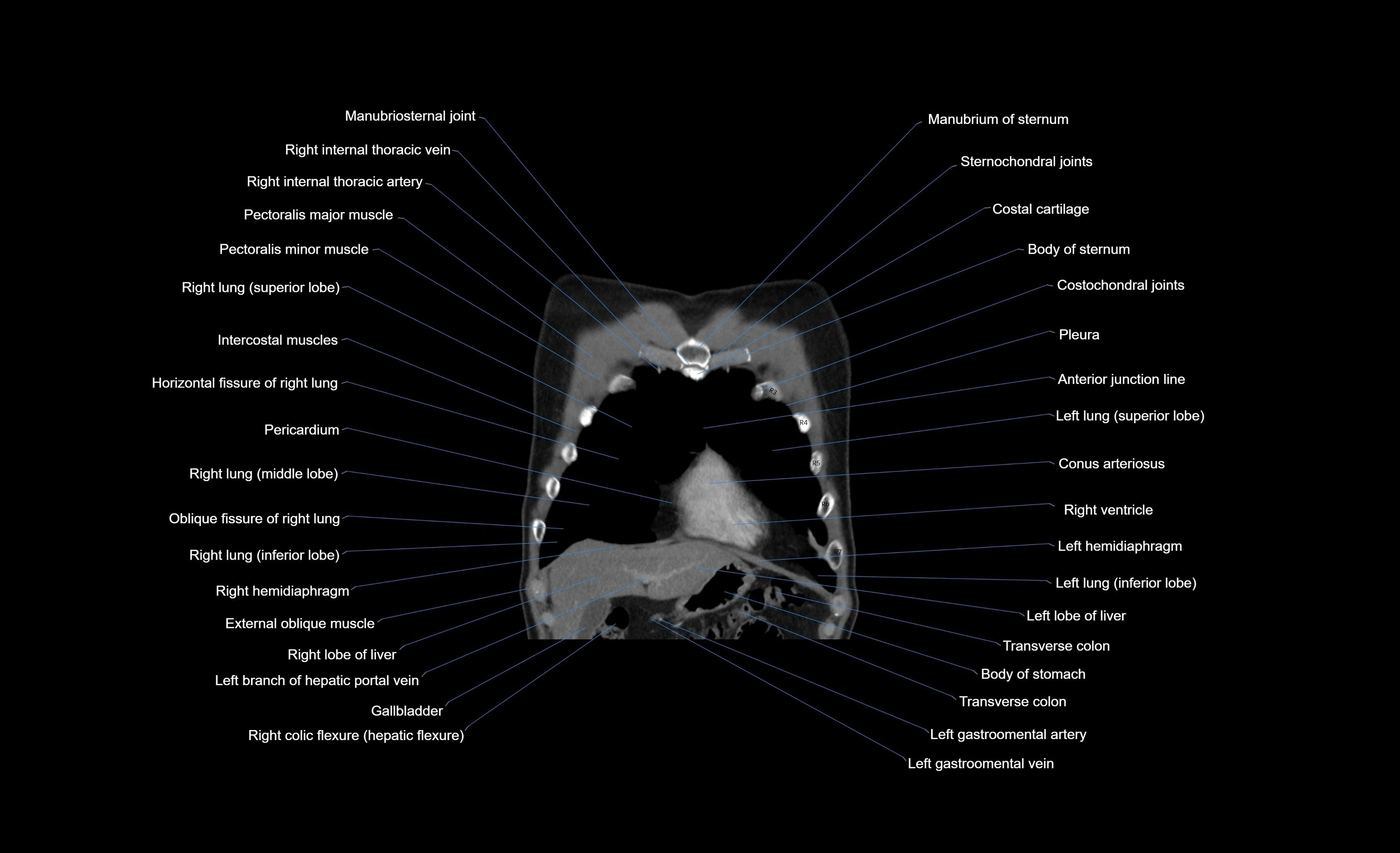 CT chest (thorax) soft tissue window labelled coronal cross sectional anatomy radiology image-00093.webp